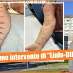 Catania. Innovativo intervento di "Linfo-DIEP" al "Cannizzaro", all'avanguardia in Italia